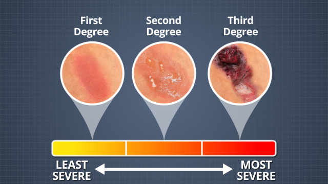 3rd degree sunburn 3rd degree sunburn